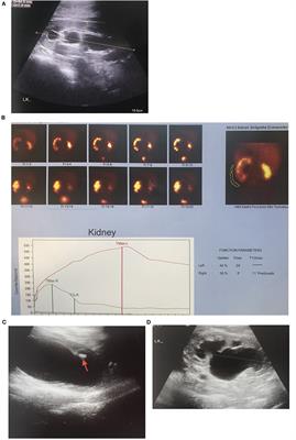 Symptomatology and Clinic of Hydronephrosis Associated With Uretero Pelvic Junction Anomalies